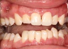 gum care after.