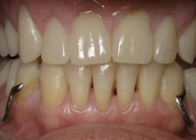 gum care after
