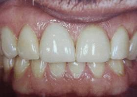 gum care after1