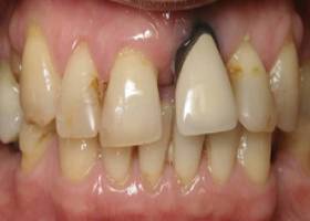 gum care before