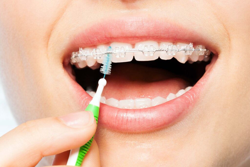How to Care for Your Braces Tips from Top Orthodontists