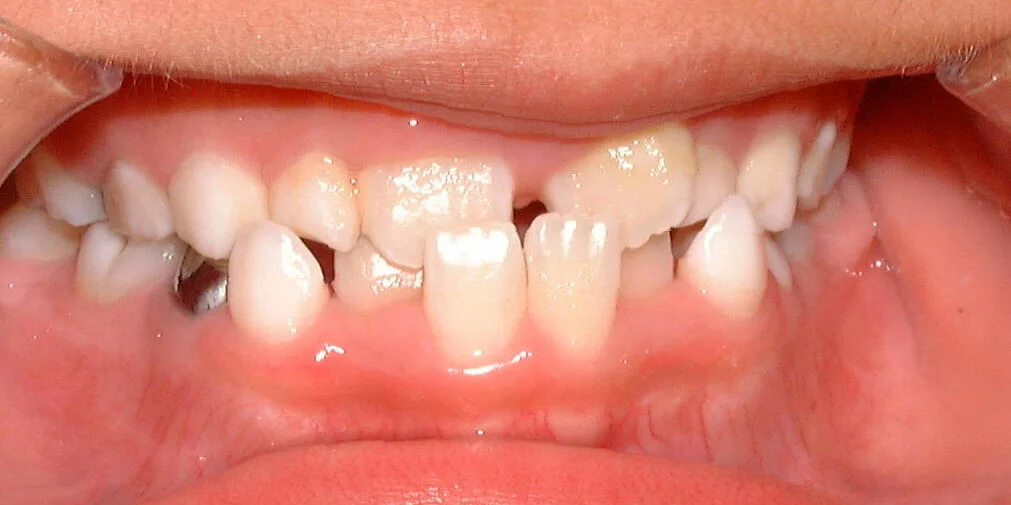 The Different Types of Bites and What They Mean